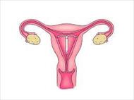 تحقیق IUD روشي براي جلوگيري از حاملگي